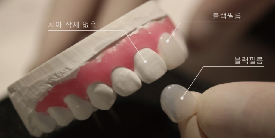 치아손상없는 깎거나 삭제없는 무삭제라미네이트가격 관련 이미지 2