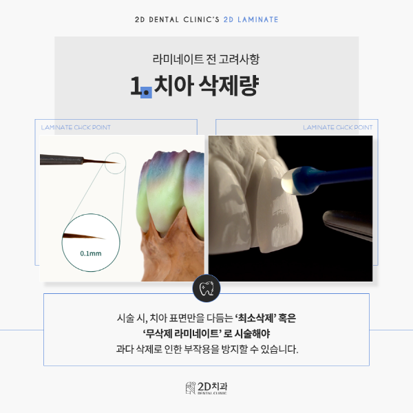 라미네이트 시술 전, 이것만은 꼭 확인하세요! 관련 이미지 3