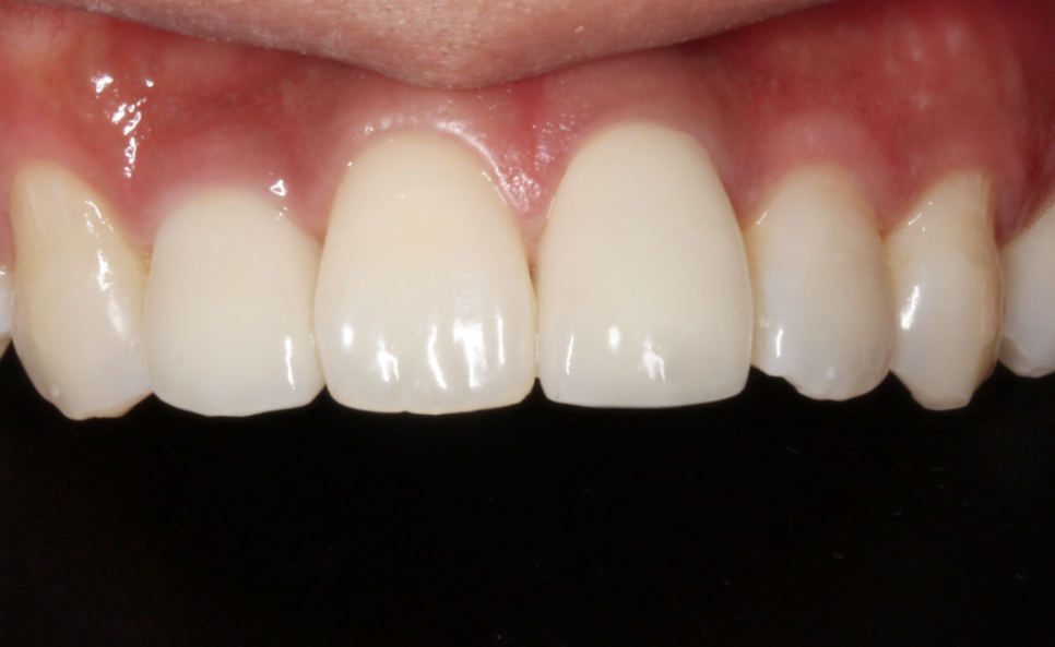 앞니깨짐 라미네이트로 자연스럽게! 관련 이미지 2
