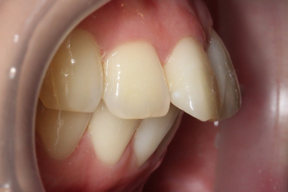 토끼앞니교정 부분교정으로 단기완성 관련 이미지 4