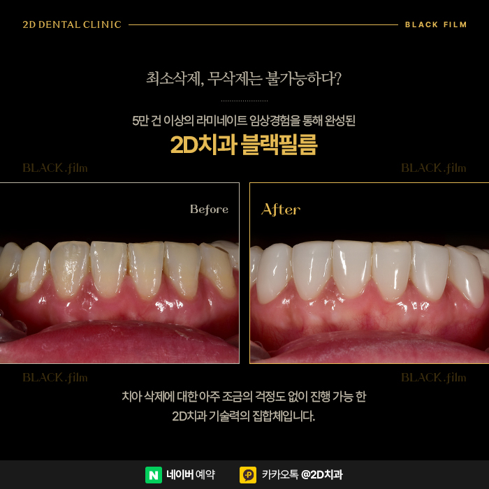 아랫니 라미네이트 가장 중요한 포인트는 삭제량, 완전 무삭제라미네이트 블랙필름 관련 이미지 6