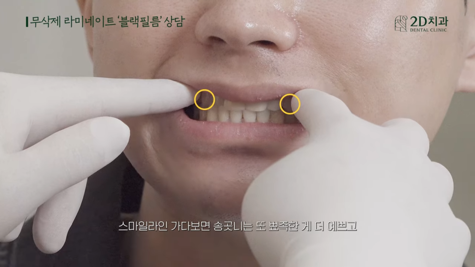 [블랙필름 상담 받고 왔어요] #4 크라운 위에 블랙필름 가능한가요? 관련 이미지 13