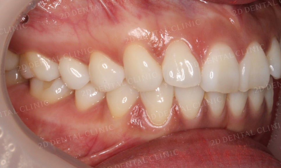 [부분교정] 틀어진 앞니, 부분교정으로 앞니교정하기! by.투디치과(2D치과) 관련 이미지 6