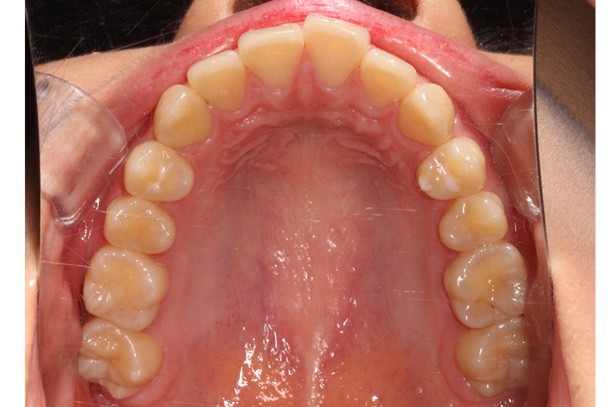 입돌출 데이몬교정 Case1 관련 이미지 6