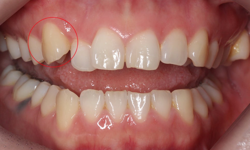 덧니교정 2D교정 (부분교정) 후기 관련 이미지 1