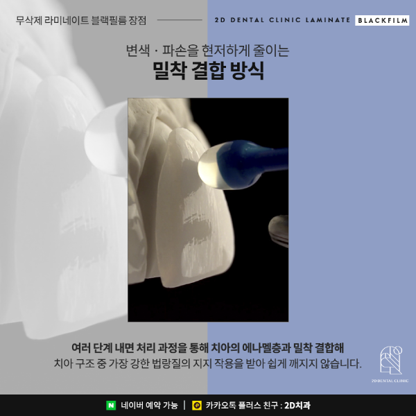 치아 삭제 없는 앞니 무삭제 라미네이트 <블랙필름> 관련 이미지 6