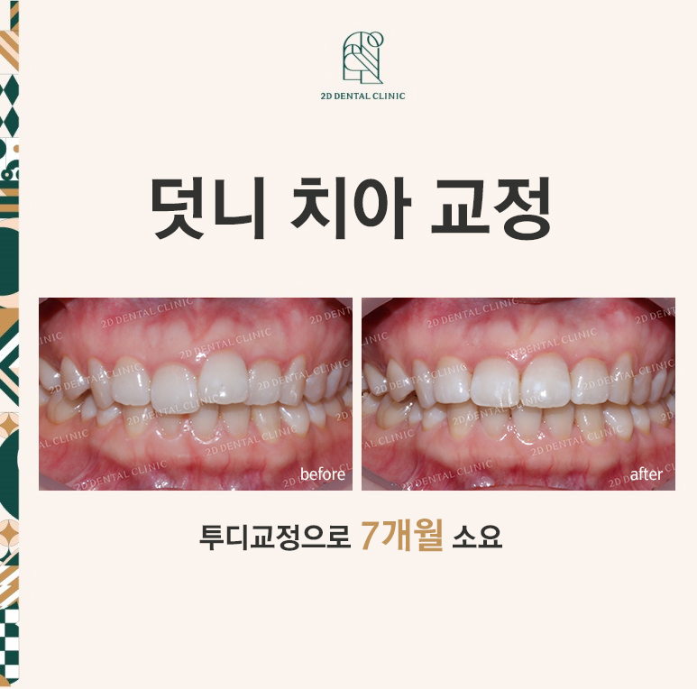 [투디교정] 덧니교정, 앞니교정으로 치열을 고르게! by.투디치과(2D치과) 관련 이미지 1