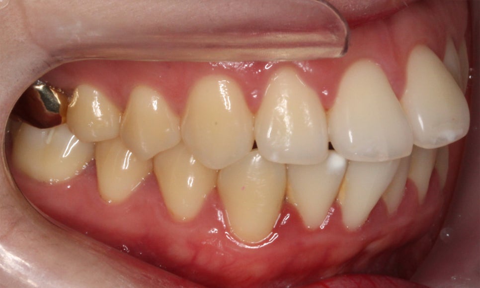 입툭튀 교정 신논현역치과 전체교정으로 관련 이미지 4