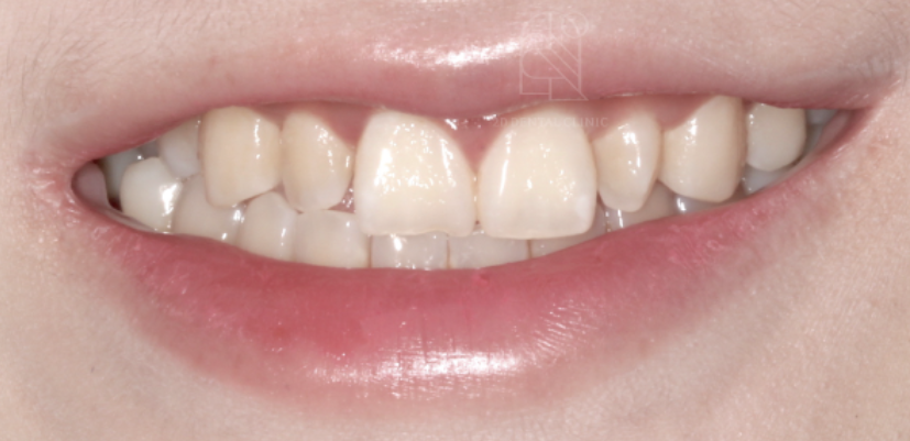 앞니라미네이트 치아삭제없는 무삭제라미네이트 블랙필름 관련 이미지 2