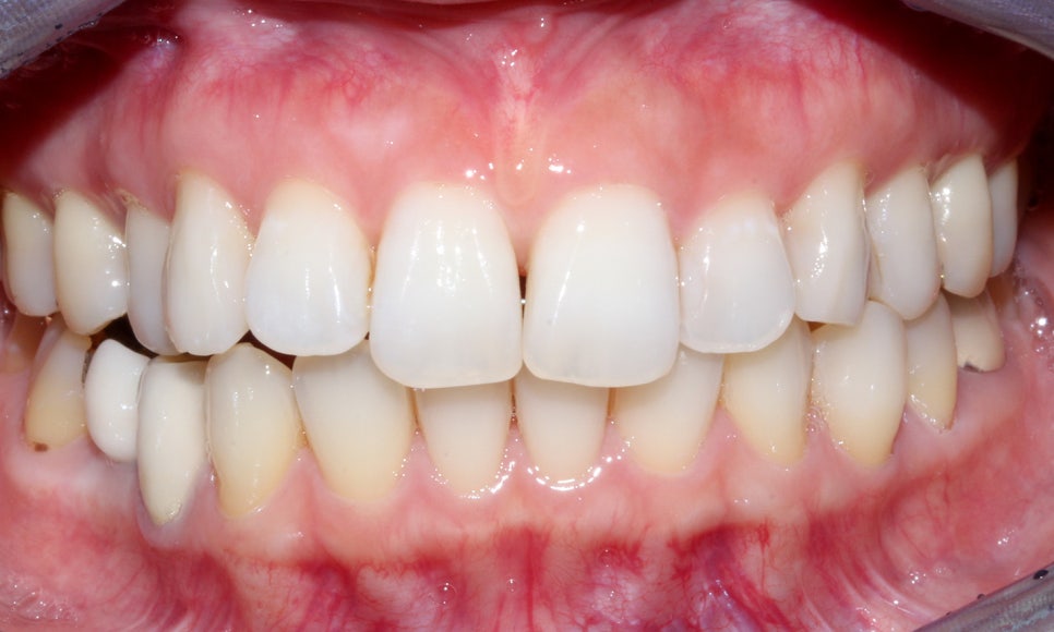 토끼 이빨 치아교정 5개월 교정 완료! by. 투디치과(2D치과) 관련 이미지 11