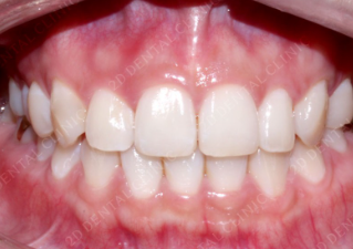 치아교정과 무삭제라미네이트 블랙필름 나에게 맞는 시술찾기 관련 이미지 4