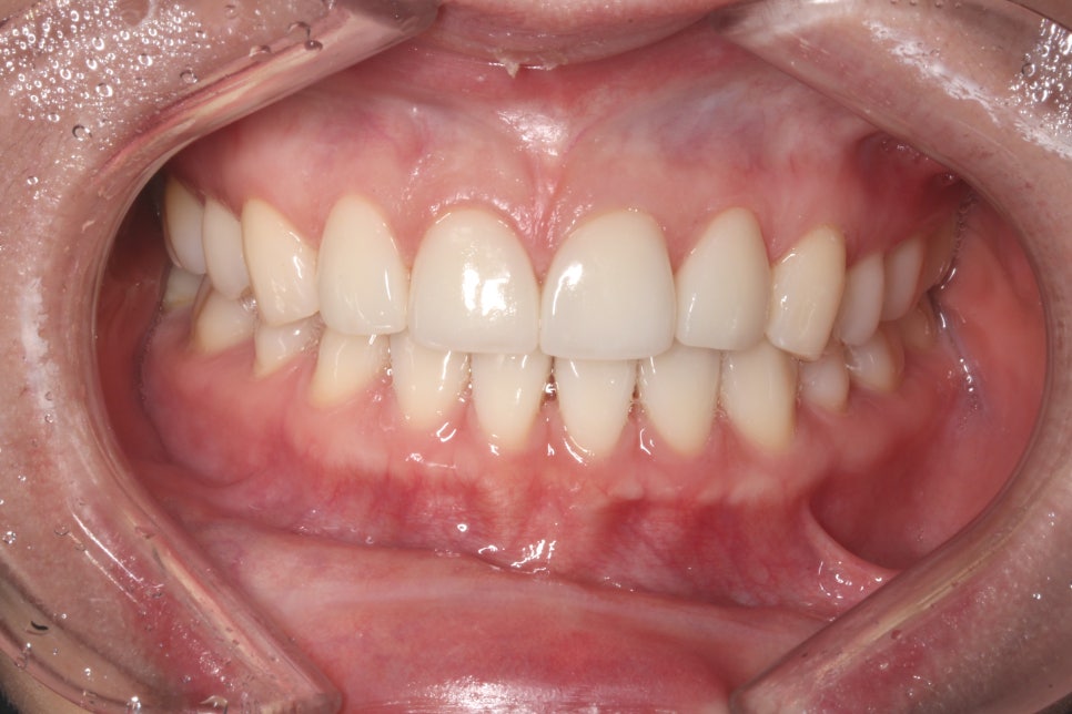 평생 소장! 앞니보철은 자연스러운 2D치과(투디치과) BLINX(블링스)로! 관련 이미지 7