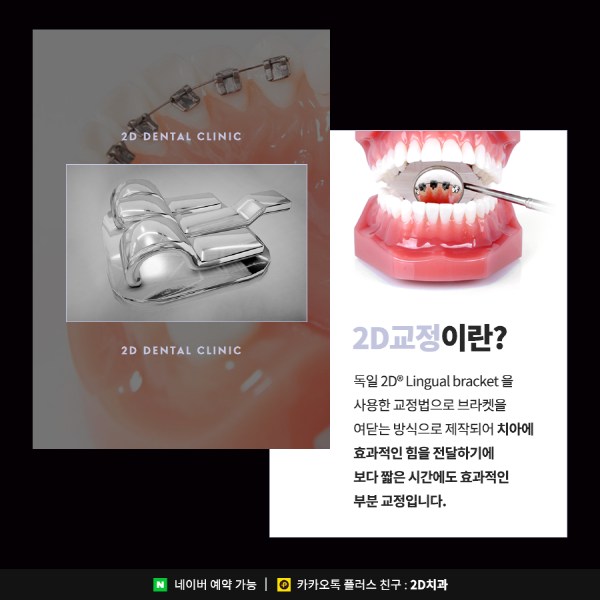 앞니치아교정, 2D교정은 관련 이미지 2