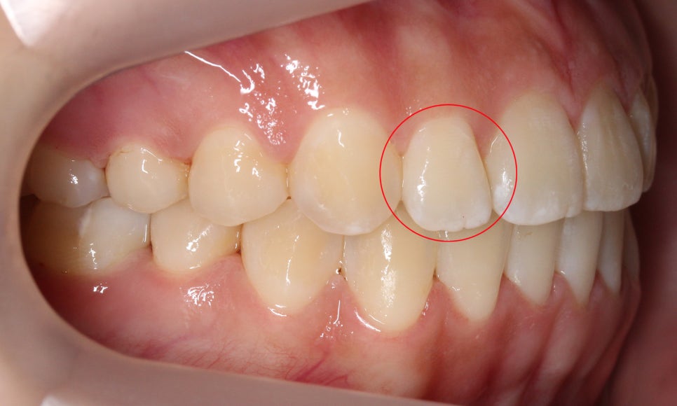톱니모양 치아를 매끄러운 치아모양으로 개선하는 방법! (마멜론치아) 관련 이미지 7