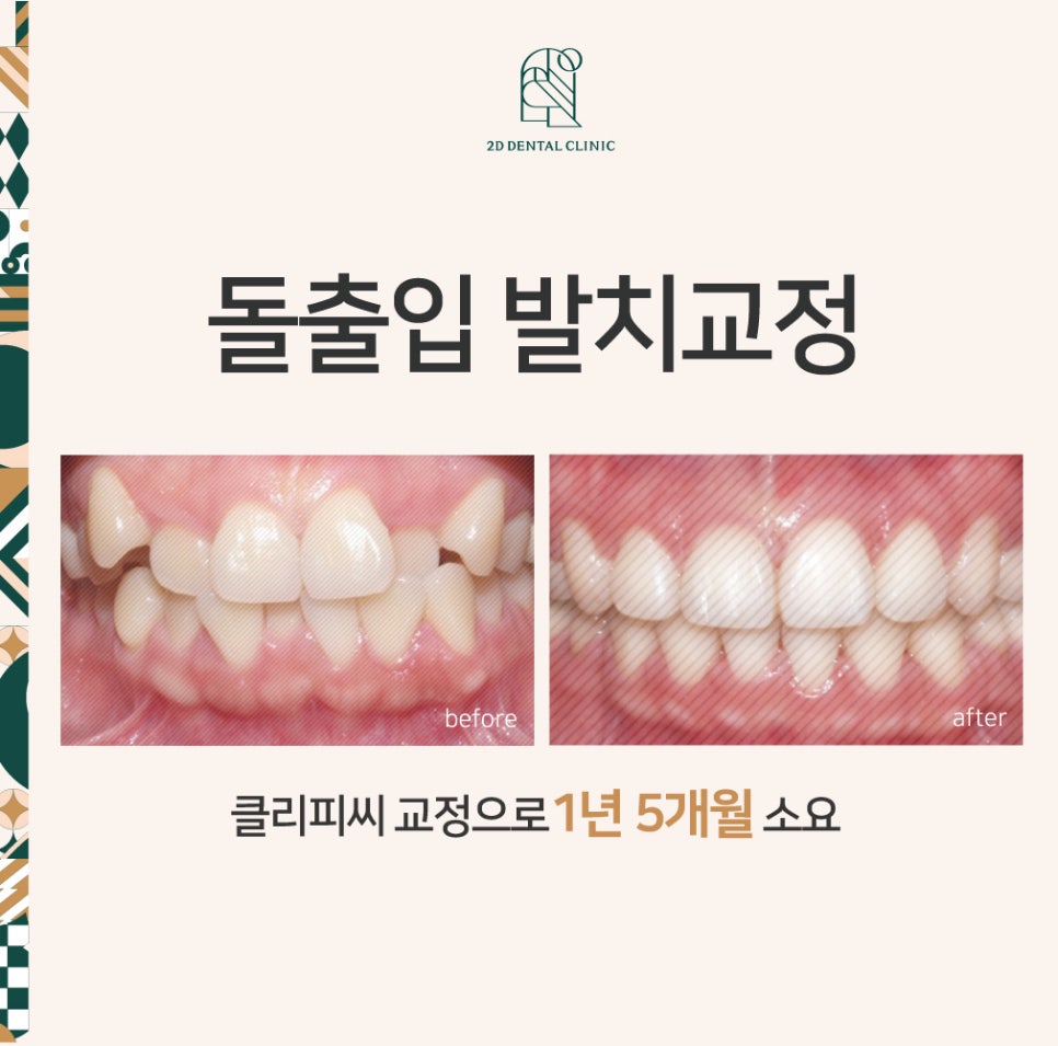 2D치과(투디치과) 돌출입 발치&덧니교정 후기 ft.크라우딩이란? 관련 이미지 1