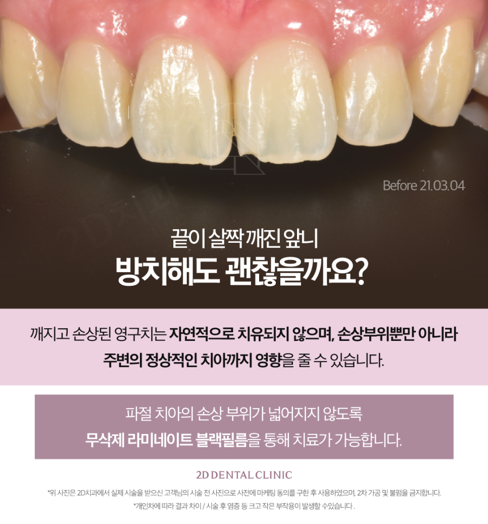 무삭제라미네이트비용 앞니살짝깨짐 더욱 큰 손상을 막기 위해서 관련 이미지 3