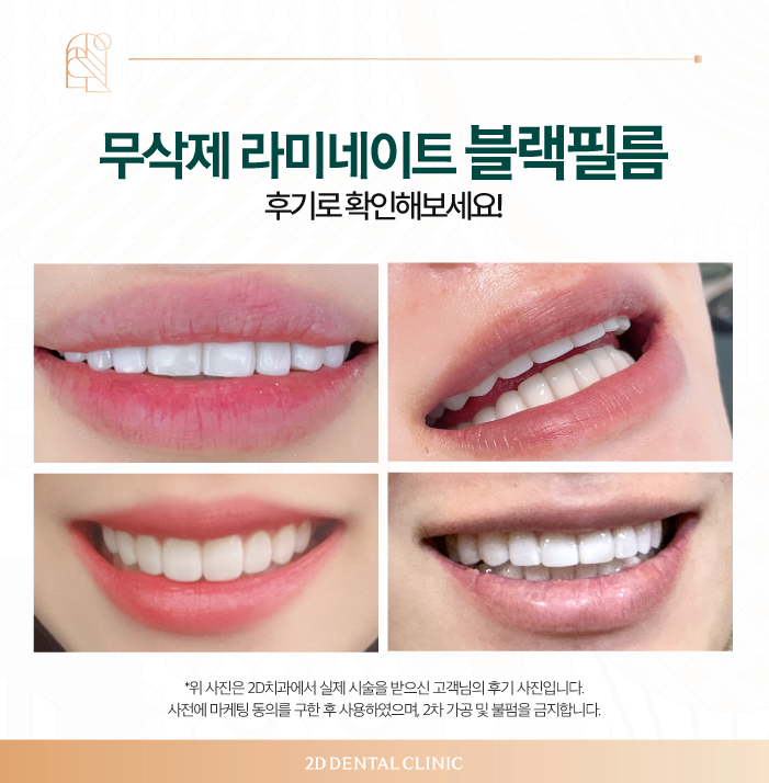 무삭제라미네이트 앞니성형 꼼꼼하게 진행하려면 관련 이미지 7