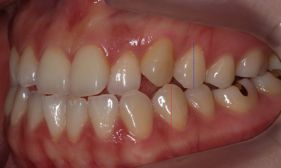 절단교합 클리피씨 교정 방법 관련 이미지 5