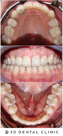 돌출입 유형 및 증상, 치과 내원 전 자가진단! 관련 이미지 13