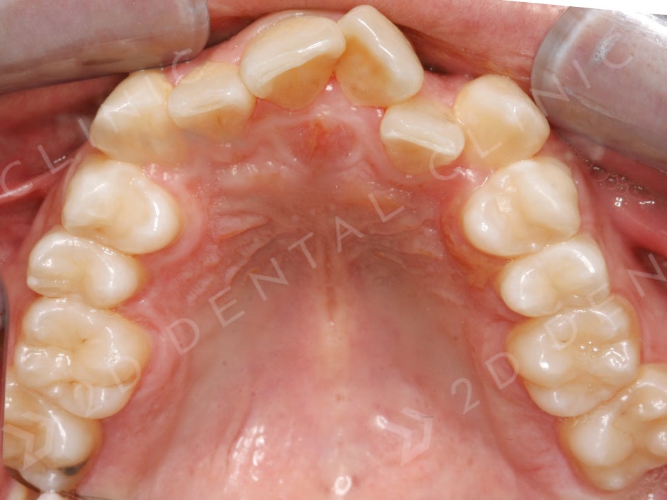 덧니만 부분교정으로 교정 할 수 있나요? 관련 이미지 3