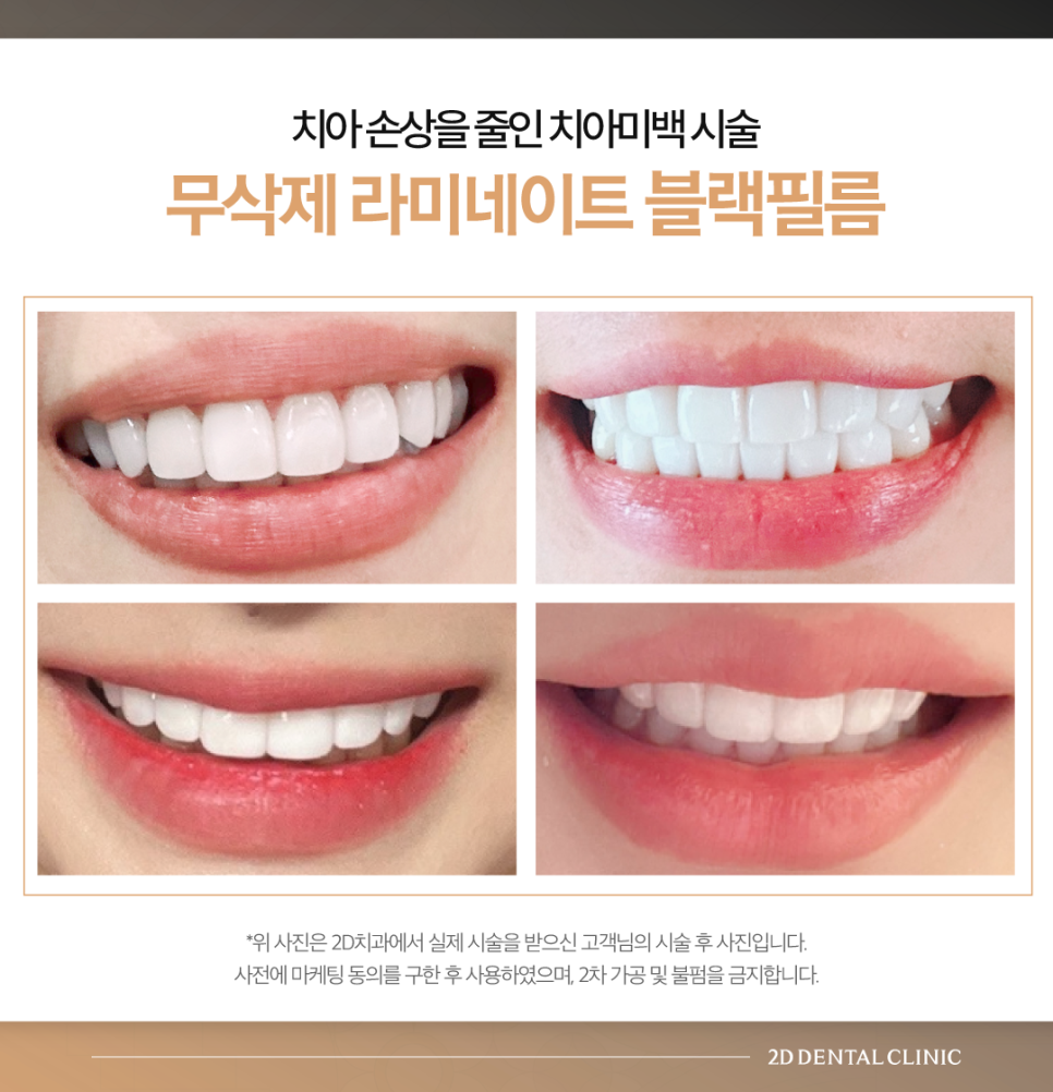 창원무삭제라미네이트 치과치아미백 어떤 방법이 좋을지 고민될 때 관련 이미지 6
