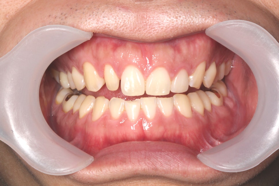 평생 소장! 앞니보철은 자연스러운 2D치과(투디치과) BLINX(블링스)로! 관련 이미지 3