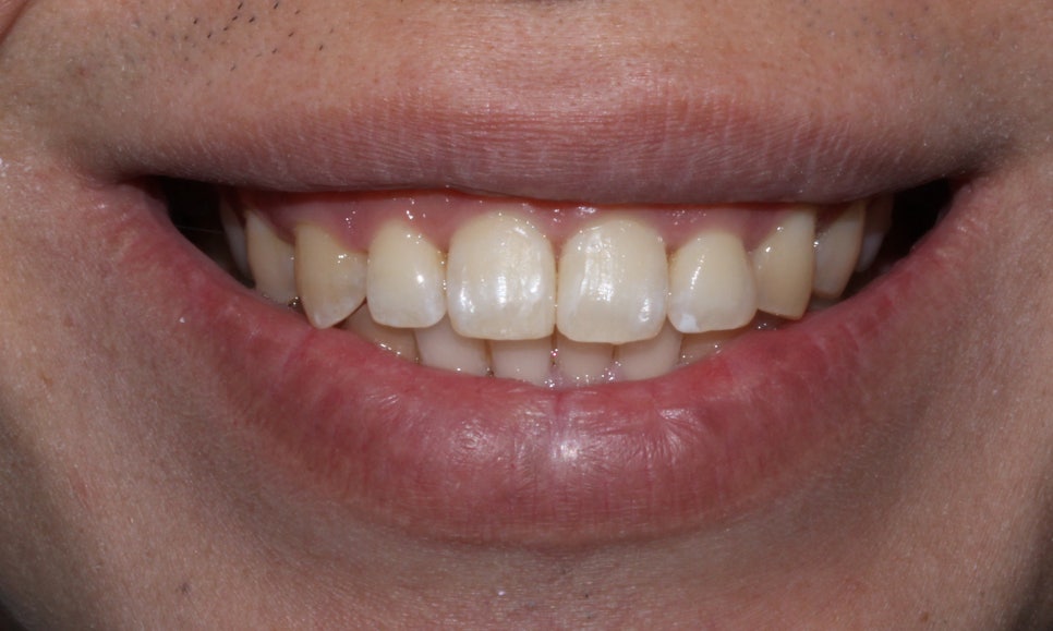 뻐드렁니 교정, 강남역치과에서 앞니 부분 교정한 후기! 관련 이미지 9