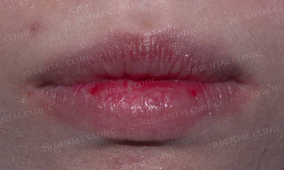 강남역 치과에서 앞니부분 설측 2D(투디)교정으로 토끼앞니 탈출한 후기 관련 이미지 2