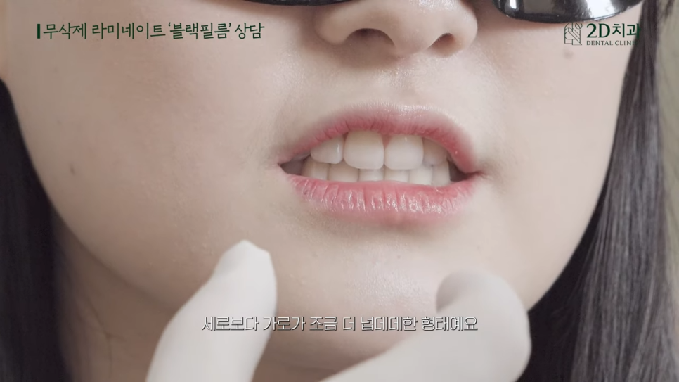 [블랙필름 상담받고 왔어요] #1 큰 앞니 작게 만들 수 있나요? 관련 이미지 9