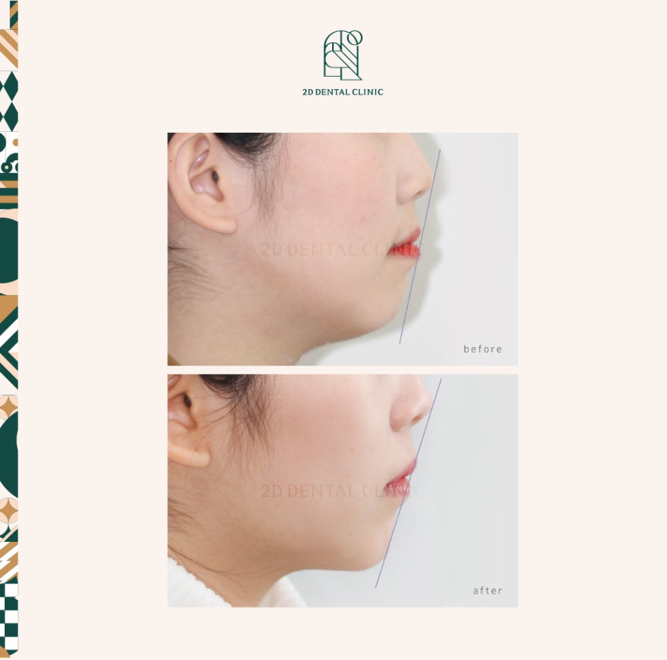 [돌출입 무턱] 안모교정 진행중! by.투디치과(투디치과)전체교정 관련 이미지 1