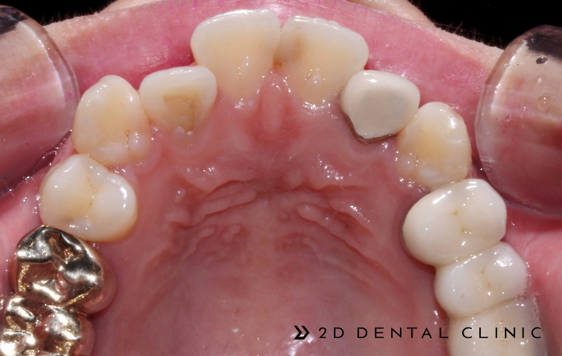 케이스로 확인하는 덧니 부정교합, 교정전문 2D치과 관련 이미지 5