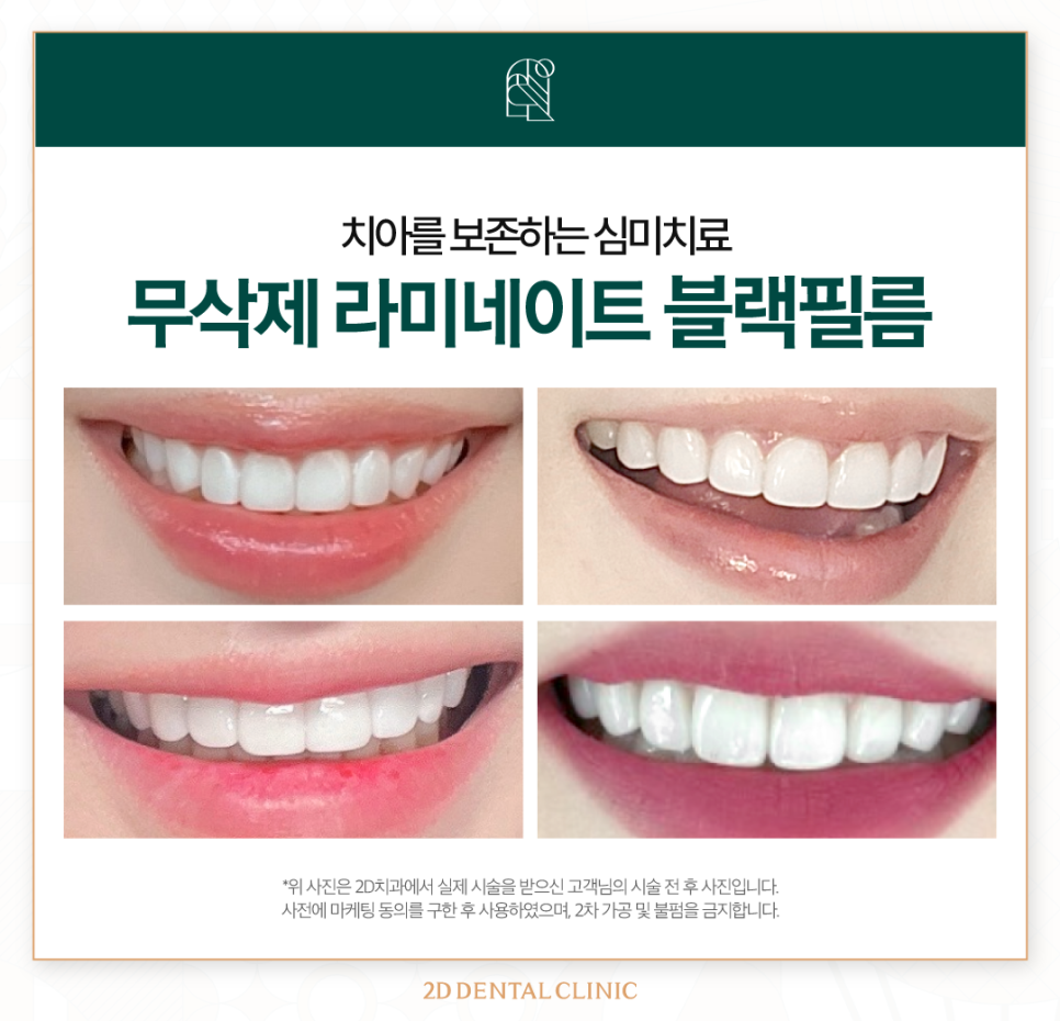 강남라미네이트 심미치료에 적합한 무삭제 블랙필름 관련 이미지 8