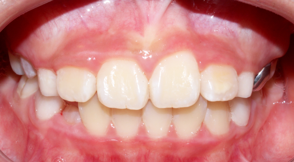 (2D)투디치과: 성장기 어린이 비발치 부정교합 후기 과정. 관련 이미지 7