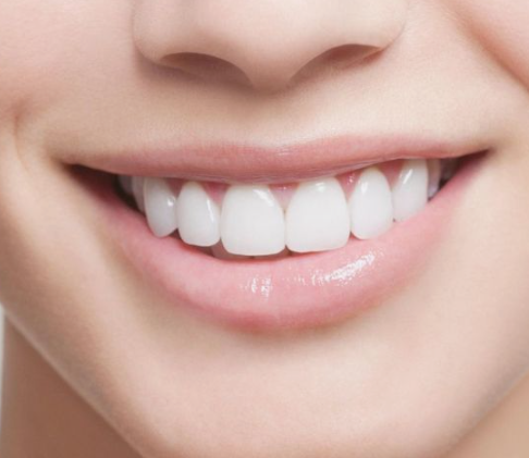 만족도 높은 치아삭제 없는 무삭제라미네이트후기 관련 이미지 2