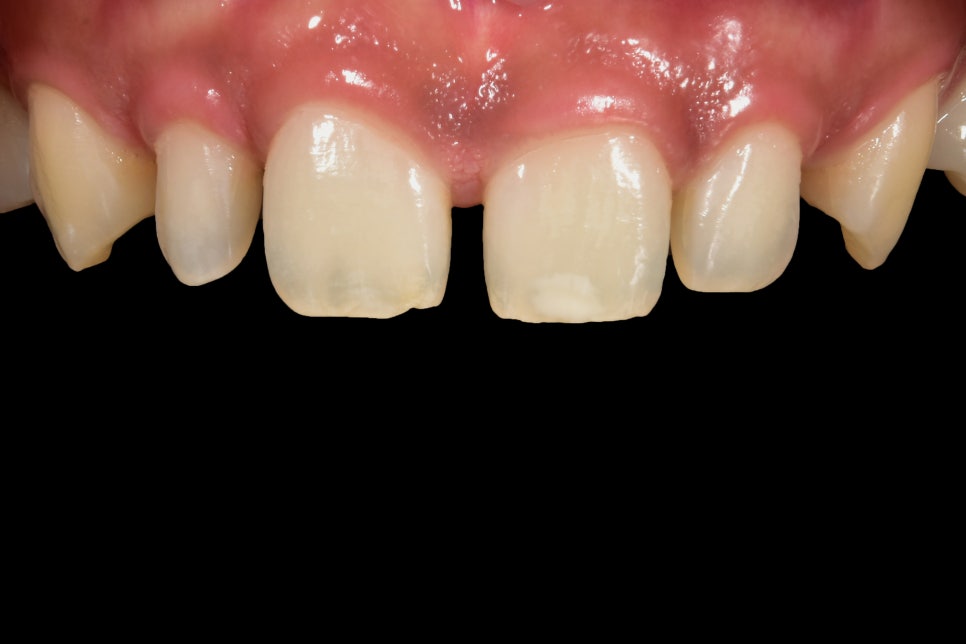 연예인라미네이트 무삭제로 잘하는 2D치과 관련 이미지 13