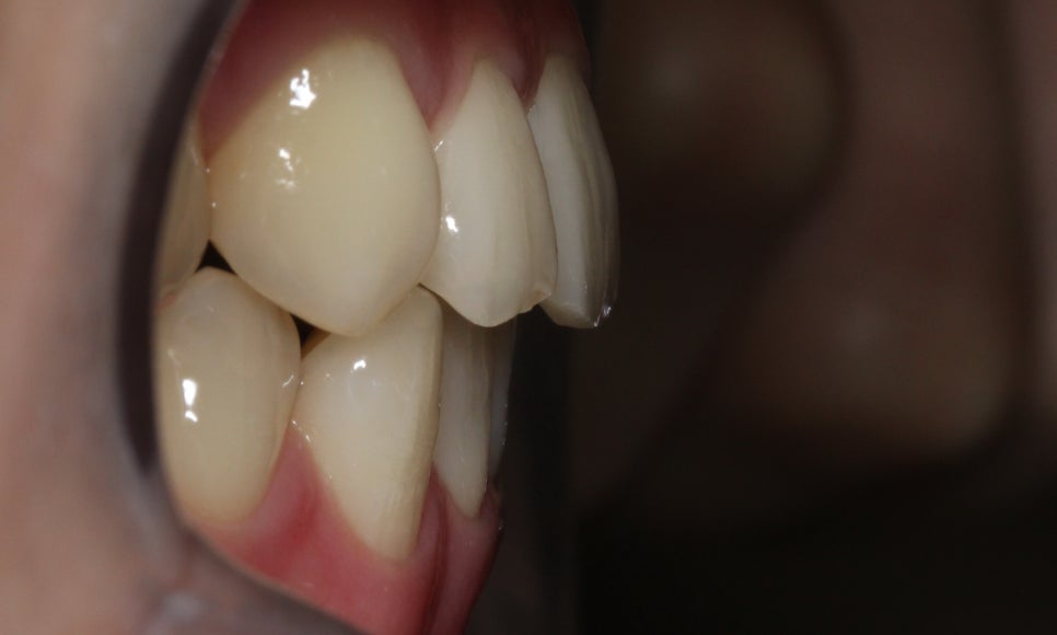 부분교정으로 삐뚤어진 앞니 예뻐지는 방법 관련 이미지 15