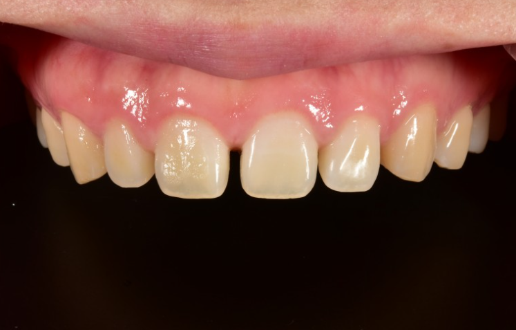 치아성형 잇몸성형 치아삭제 없는 무삭제라미네이트 블랙필름 관련 이미지 3