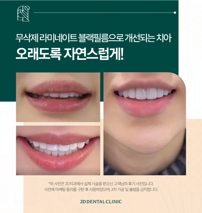 대구무삭제라미네이트 시술 후에도 철저한 사후관리 관련 이미지 6