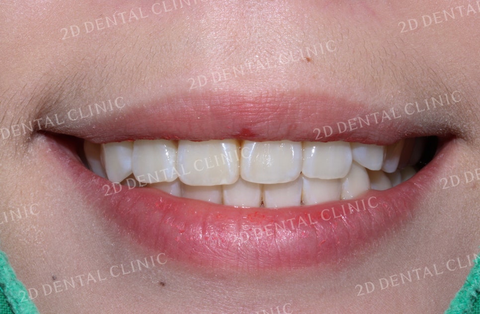 돌출입, 돌출앞니를 부분교정으로 고르게! by.투디치과(2D치과) 관련 이미지 7