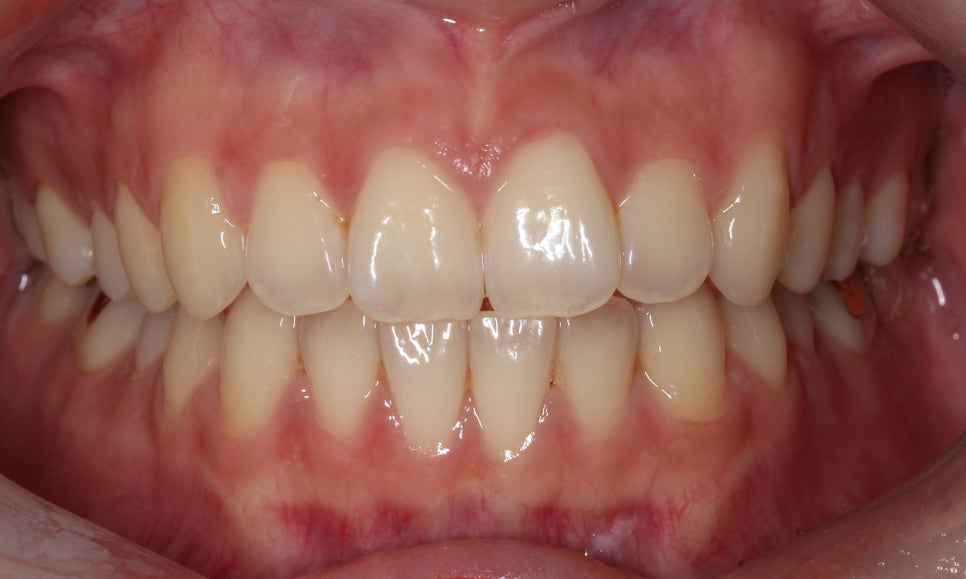 나비앞니 세라믹교정 case 관련 이미지 1