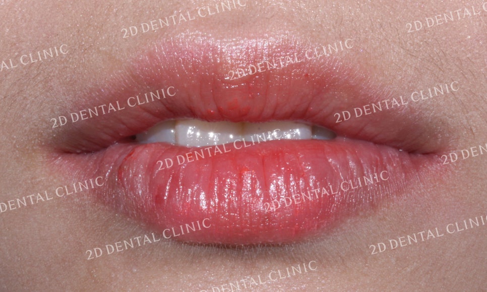 [투디교정] 덧니치아교정, 부분교정으로 쉽고 빠르게! by.투디치과(2D치과) 관련 이미지 2