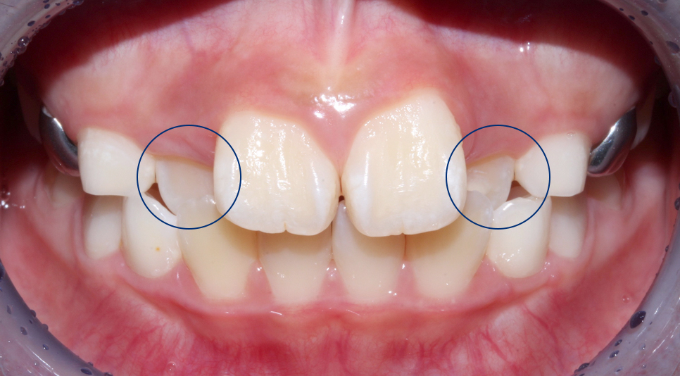 (2D)투디치과: 성장기 어린이 비발치 부정교합 후기 과정. 관련 이미지 3