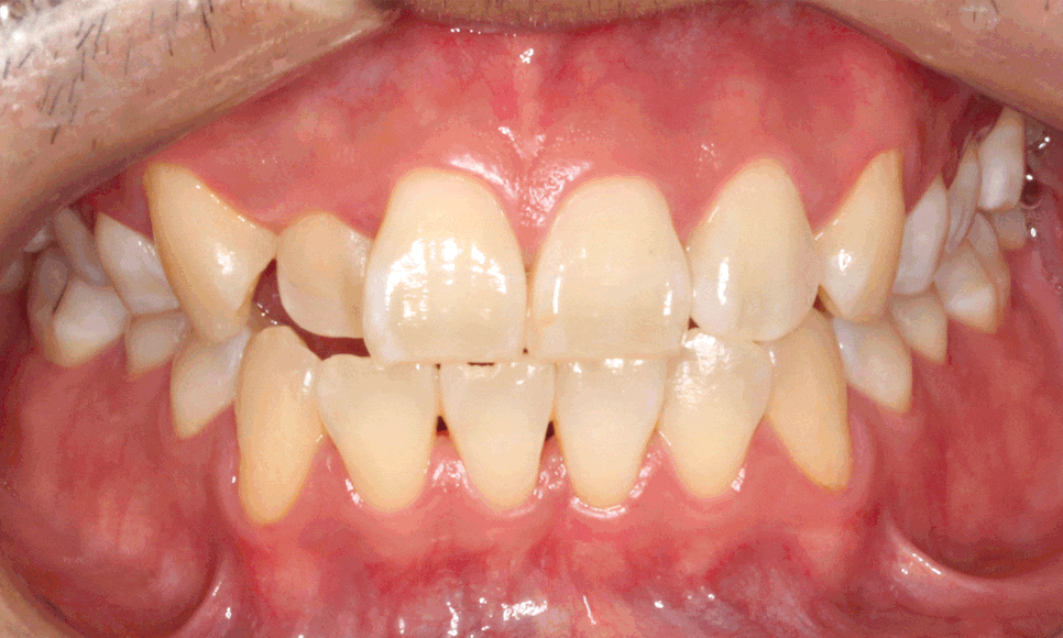 앞니 덧니 고민, 부분 설측 교정으로 해결한 사례 관련 이미지 1