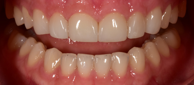 라미네이트잘하는곳 무삭제라미 블랙필름 2D치과 관련 이미지 5