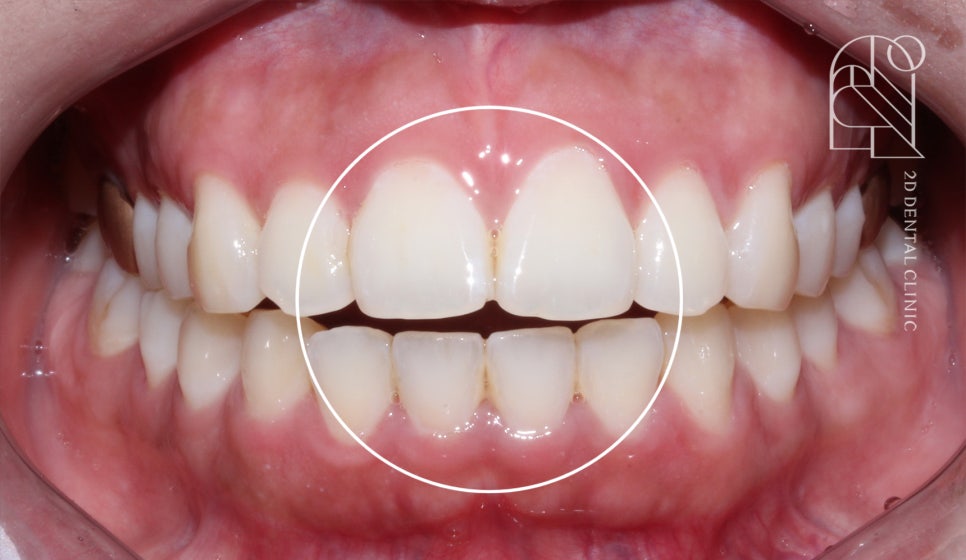 부정교합 치아교정, 전체교정으로 완성하기! by. 투디치과(2D치과) 관련 이미지 2