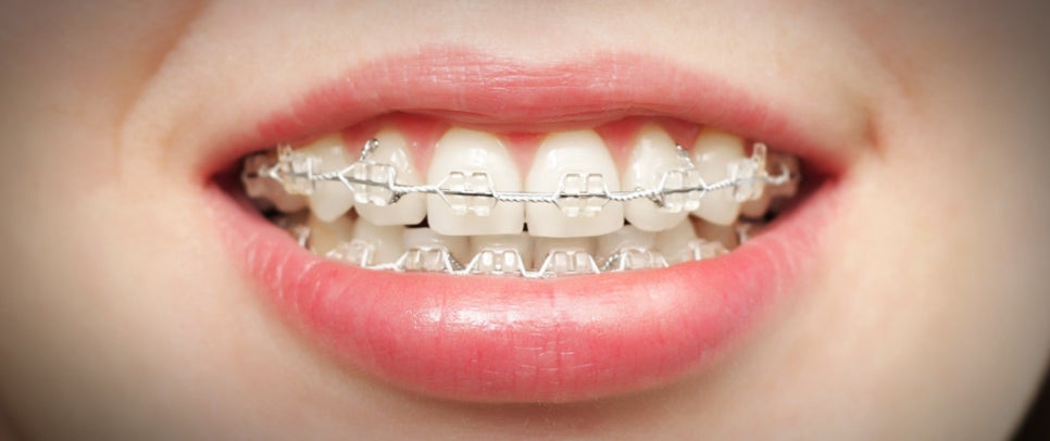 2D(투디)치과교정 후 관리는 어떻게 해야 할까? 관련 이미지 3