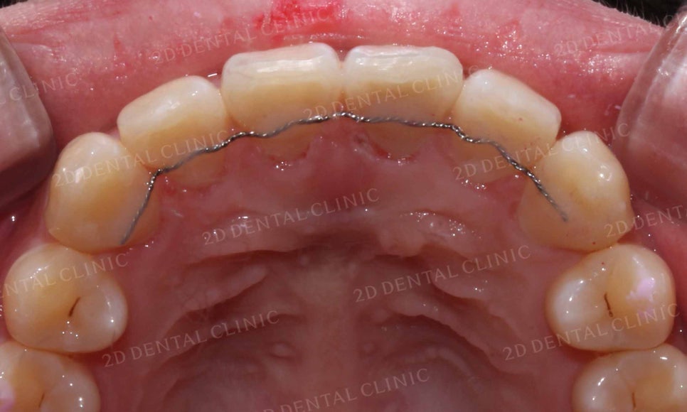 강남역 치과에서 앞니부분 설측 2D(투디)교정으로 토끼앞니 탈출한 후기 관련 이미지 17