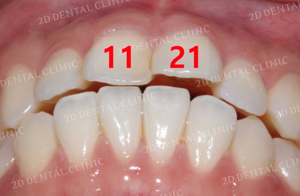 비대칭 앞니, 돌출앞니를 전체 교정으로 교정하고 싶다면!? by.투디치과(2D치과) 관련 이미지 2
