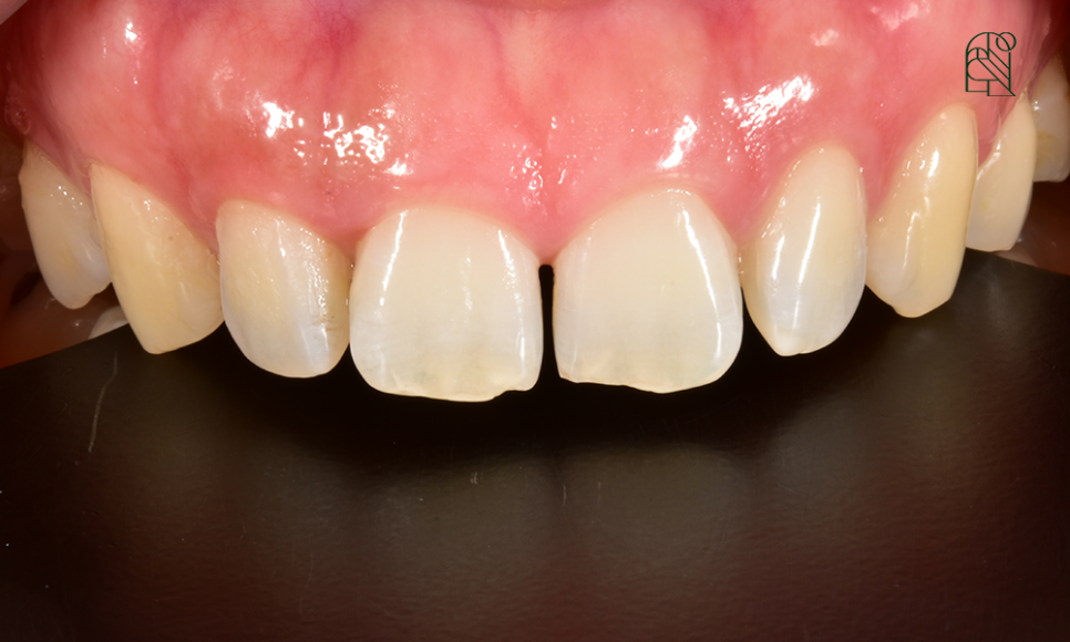 벌어진 앞니, 앞니벌어짐(diastema) 치료 - 레진, 교정, 라미네이트 관련 이미지 2