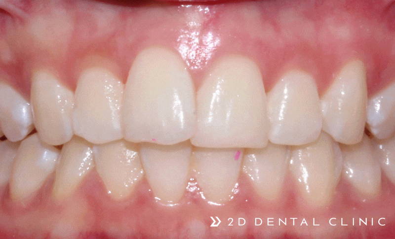앞니 덧니 부분교정 케이스 전후비교, 교정전문 2D치과 관련 이미지 7